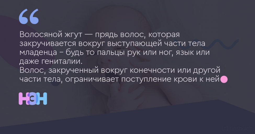 Волосяной жгу. Эффект волосяного жгута. Синдром волосяного жгута у детей.