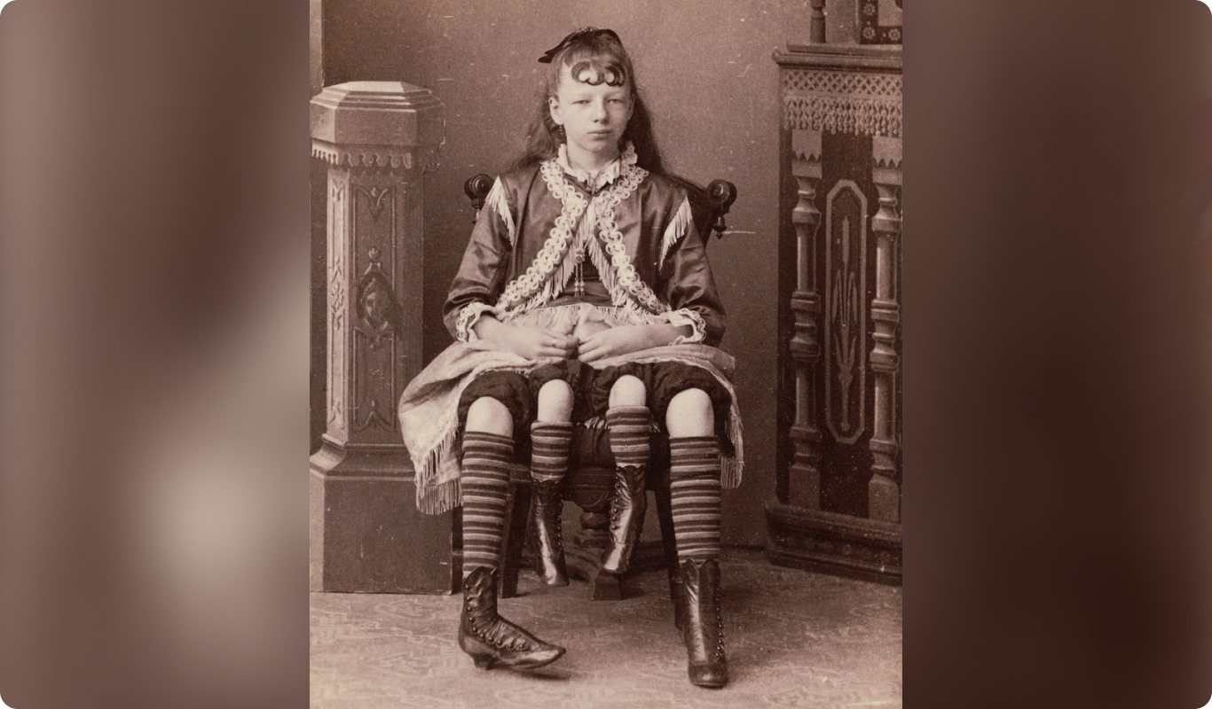 Четвероногая девочка из Техаса: невероятная история Жозефины Мертл Корбин