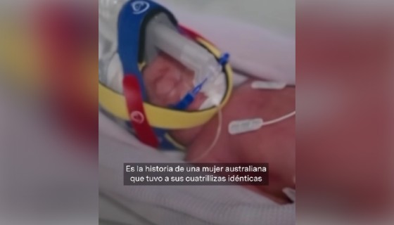 Австралийка родила редчайших однояйцевых четверняшек