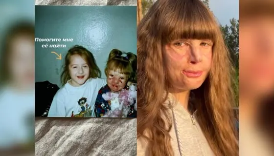 Спустя 20 лет девушка нашла подругу, которая поддерживала ее в ожоговом отделении